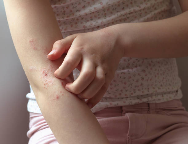 Colombia es uno de los países con más casos de Dermatitis Atópica en niños a nivel mundial