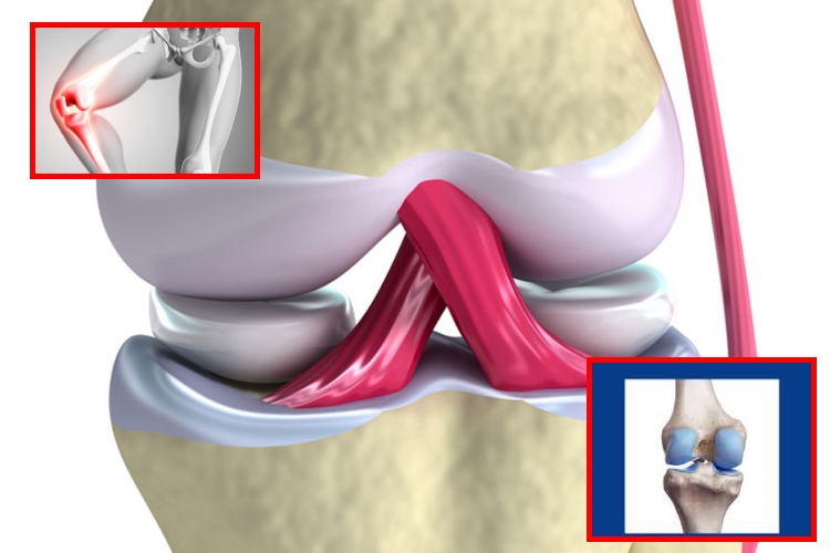 Cartílago artificial que imita la flexibilidad humana