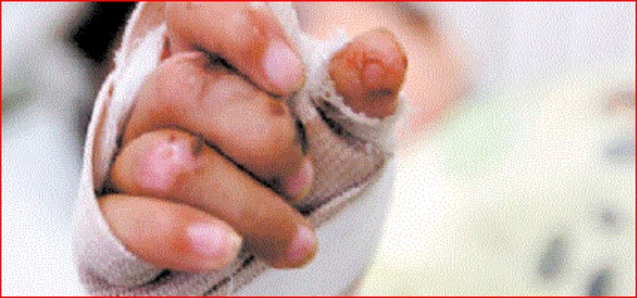 Cifras quemados- pólvora- INS- Medellín- niños- 8Dic-