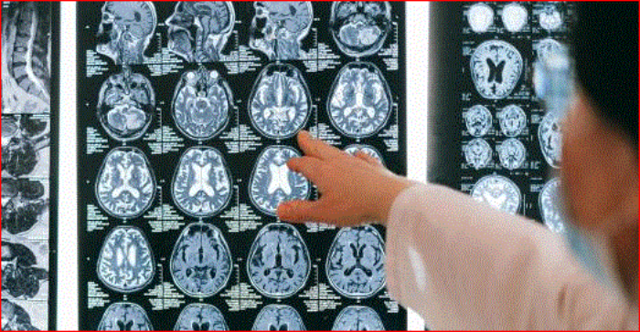 Japón- parkinson- Sumitomo Pharma- células madres- sintómas- iPS- Premio Nobel- Shinya Yamanaka-